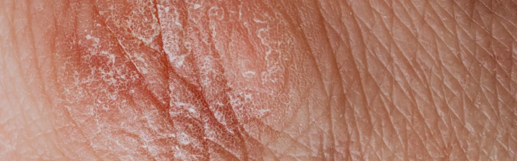 La peau sèche et déshydratée entraîne nombre d'inconforts